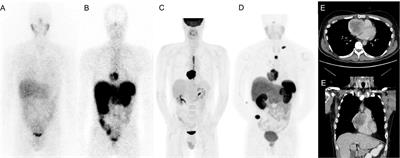 Highly Symptomatic Progressing Cardiac Paraganglioma With Intracardiac Extension Treated With 177Lu-DOTATATE: A Case Report